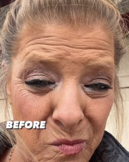 Before and after Xeomin neurotoxin and Dermal filler applications. This client said she thought the days of pictures without filters were gone for her…..until now!! Let me help you bring back your beautiful!!! Book your appointment today!!! @revitalizing_yourhealth #NOfilterNeeded #youmakemefeellikeanaturalwoman #DermalFillers #neurotoxininjections #ReVITALizeYOU